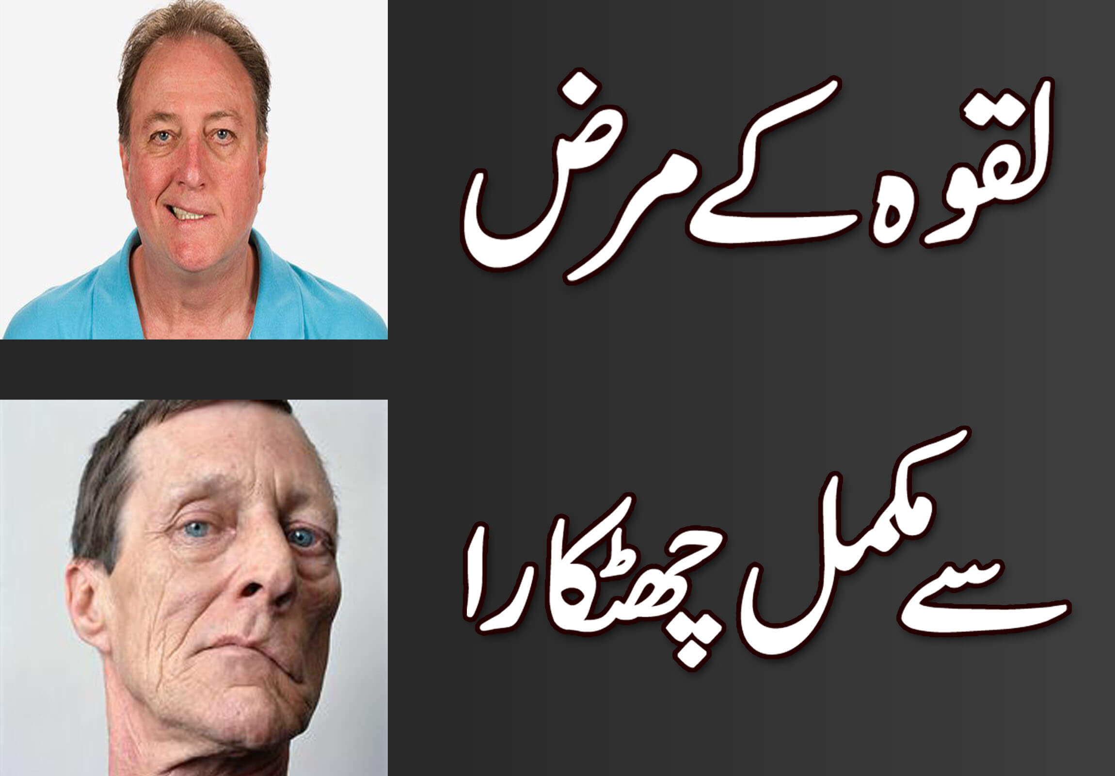 Bells Palsy – لقوہ کے مرض سے مکمل چھٹکارا