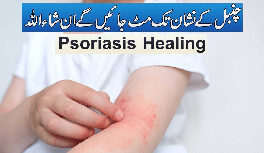 Chambal (Psoriasis) Ka Rohani Ilaj