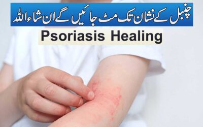 Chambal (Psoriasis) Ka Rohani Ilaj
